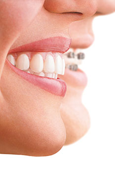 About Invisalign Treatment