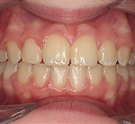 Prominent Teeth  After